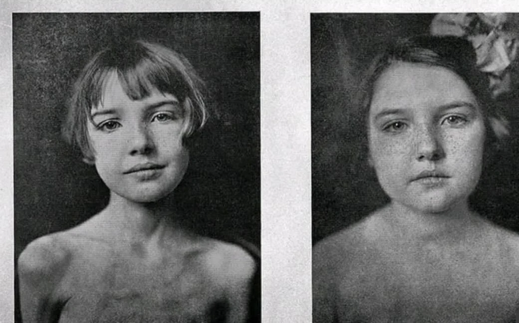 Case VI: до инсулина — и четыре месяца спустя